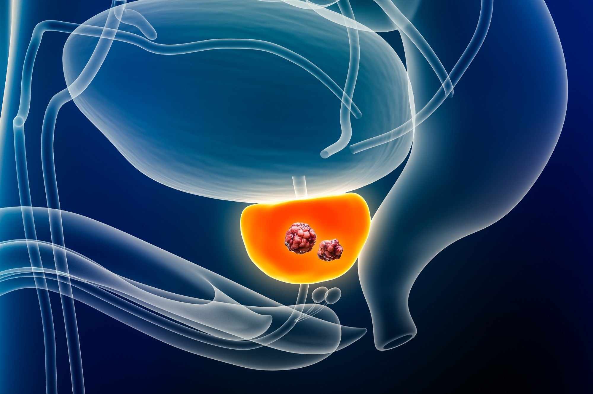 AI Helps Predict Prostate Cancer Without Biopsy