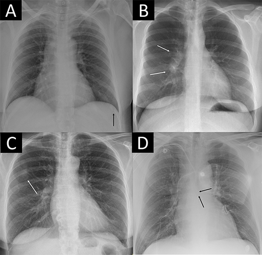 Four examples of remarkable chest X-rays with missed critical findings.