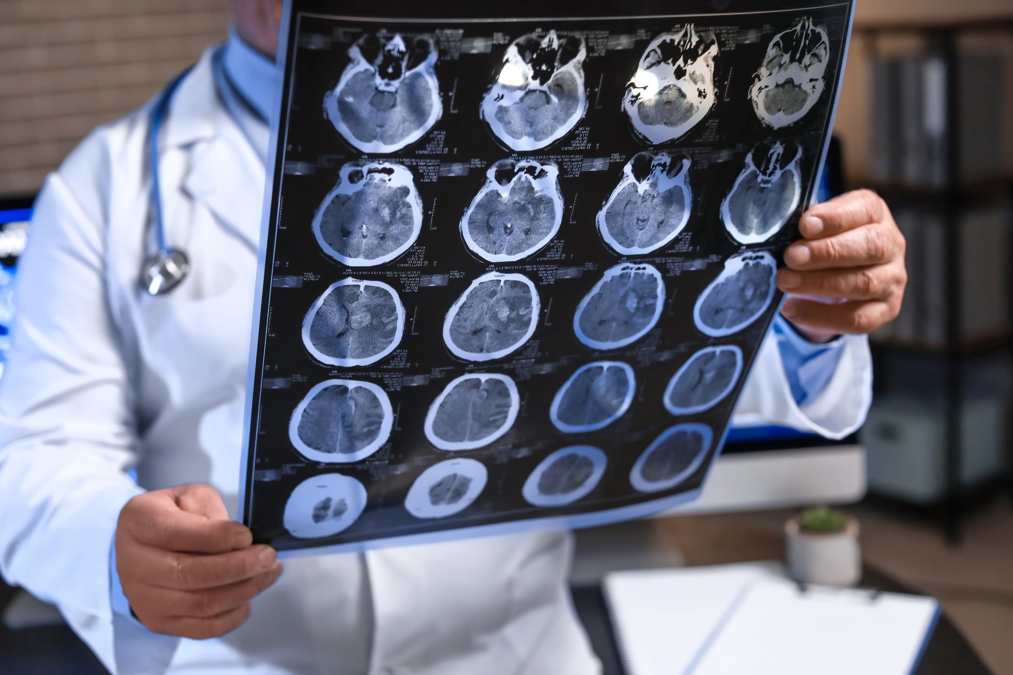 AI Tool Aims for Early Dementia Detection