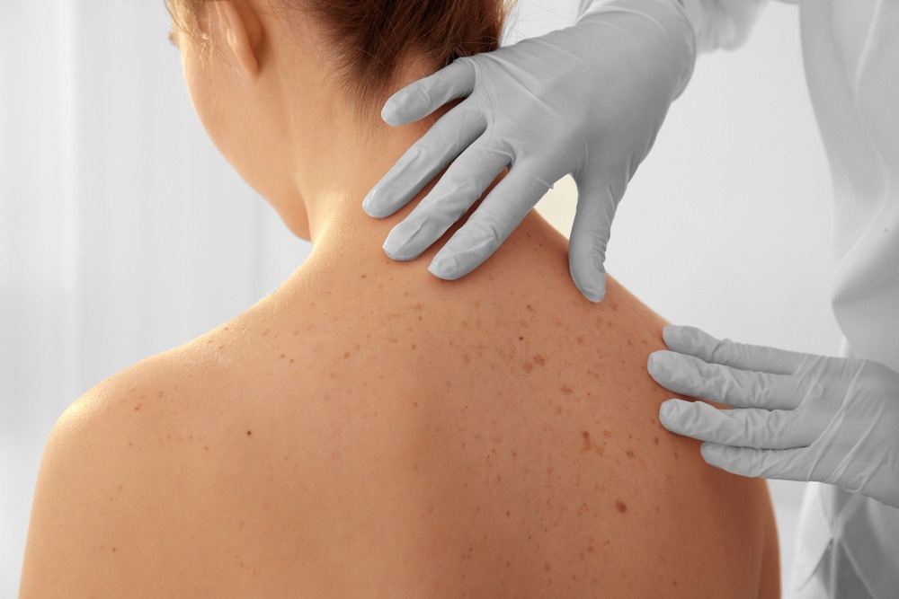 skin cancer