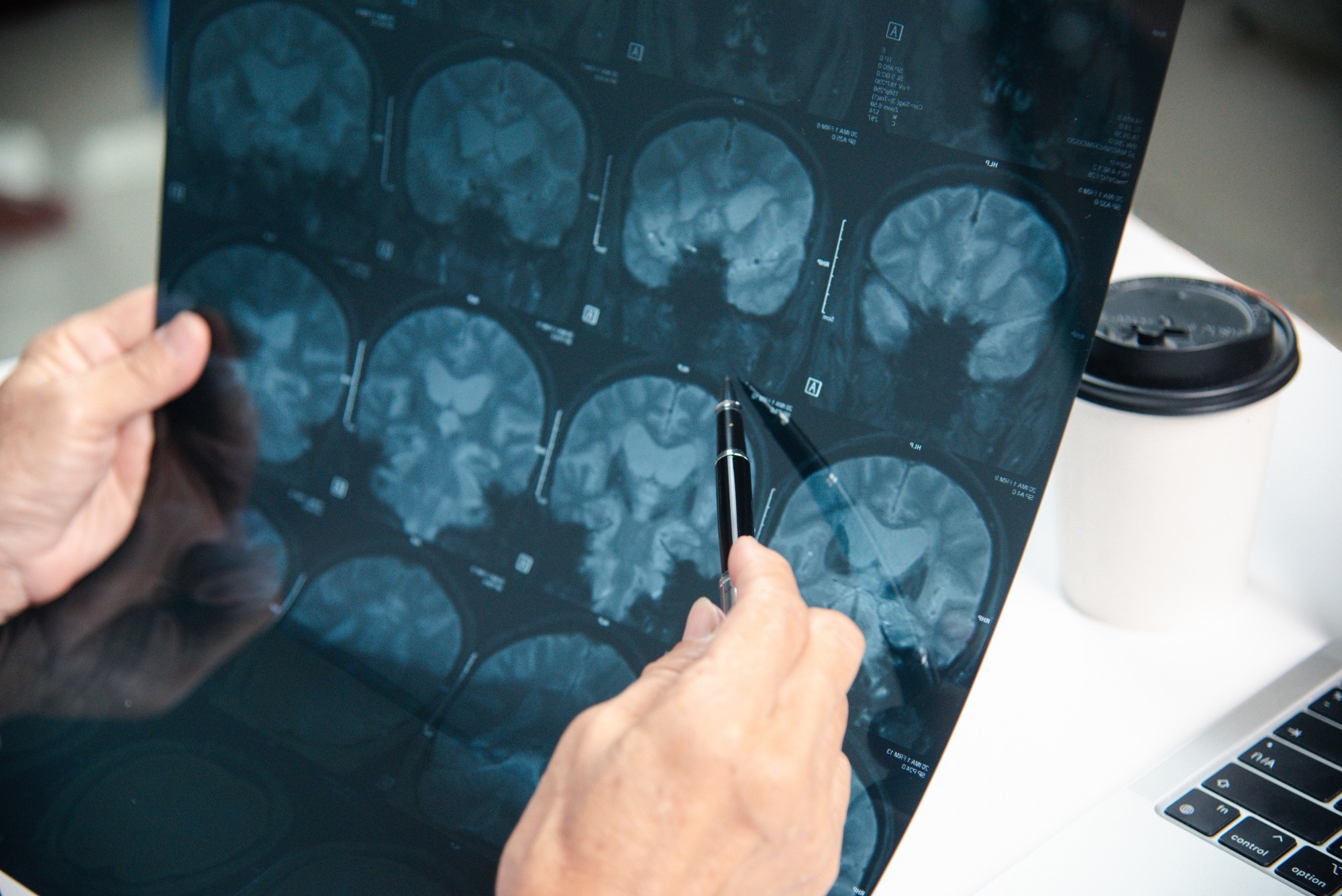 Deep Learning Elevates Brain Surgery Precision