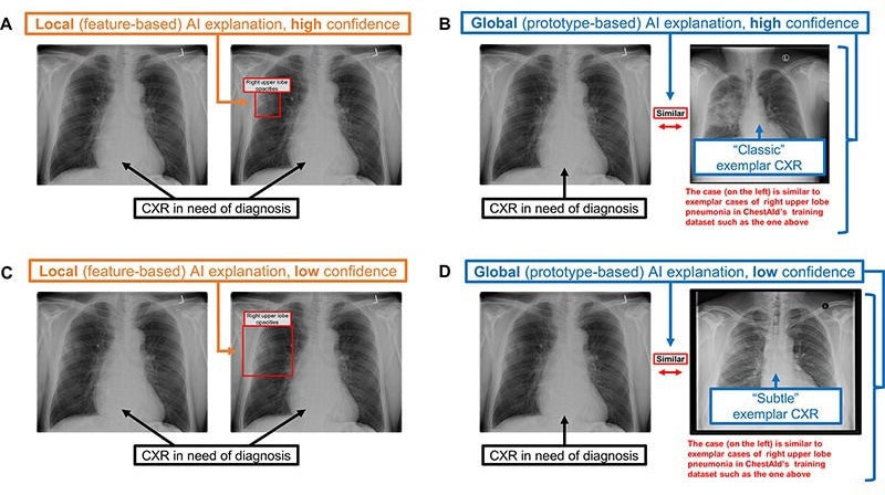 Chest radiograph (CXR) examples of (A, C) local (feature-based) AI explanations and (B, D) global (prototype-based) AI explanations from a simulated AI tool, ChestAId, presented to physicians in the study. In all examples, the correct diagnostic impression for the radiograph case in question is “right upper lobe pneumonia,” and the corresponding AI advice is correct. The patient clinical information associated with this chest radiograph was “a 63-year-old male presenting to the Emergency Department with cough.” To better simulate a realistic AI system, explanation specificity was changed according to high (ie, 80%-94%) or low (ie, 65%–79%) AI confidence level: bounding boxes in high-confidence local AI explanations (example in A) were more precise than those in low-confidence ones (example in C); high-confidence global AI explanations (example in B) had more classic exemplar images than low-confidence ones (example in D), for which the exemplar images were more subtle.