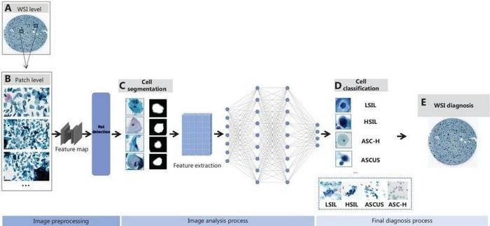 Schematic representation of AI-assisted cervical cytology image analysis. (A) Whole slide image (WSI) level: Digitalization of cervical liquid-based preparation samples; (B) Patch level: WSIs are divided into smaller patches to create feature maps, focusing on significant cellular structures and detects regions of interest (ROIs); (C) Cell segmentation: Segmentation isolates nuclei from each cell, emphasizing morphologic features; (D) Cell classification: The extracted features classify cells into categories, such as LSIL, HSIL, ASC-H, and ASCUS; (E) WSI diagnosis: The classification results are aggregated to provide an overall diagnosis at the WSI level.