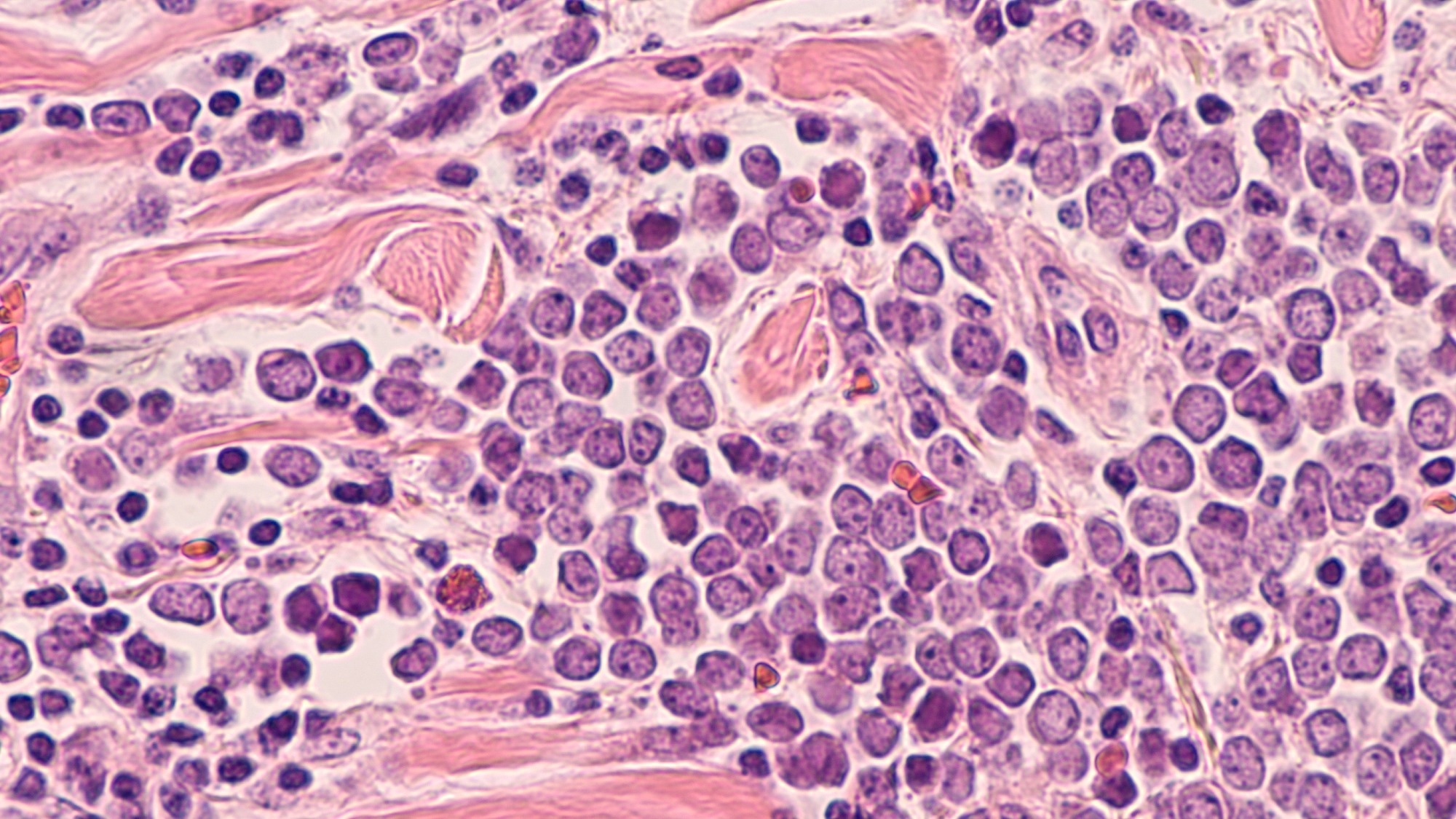Microscopic image (photomicrograph) of a Merkel cell carcinoma, a highly aggressive type of skin cancer.
