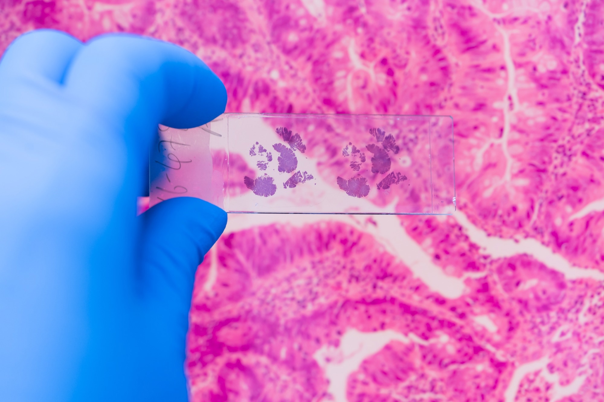 Scientist in blue gloves hand holding glasses slide breast tissue.