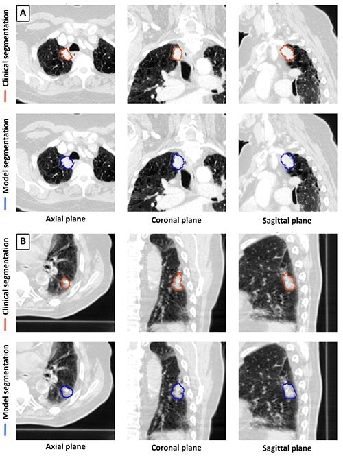 lung cancer imaging