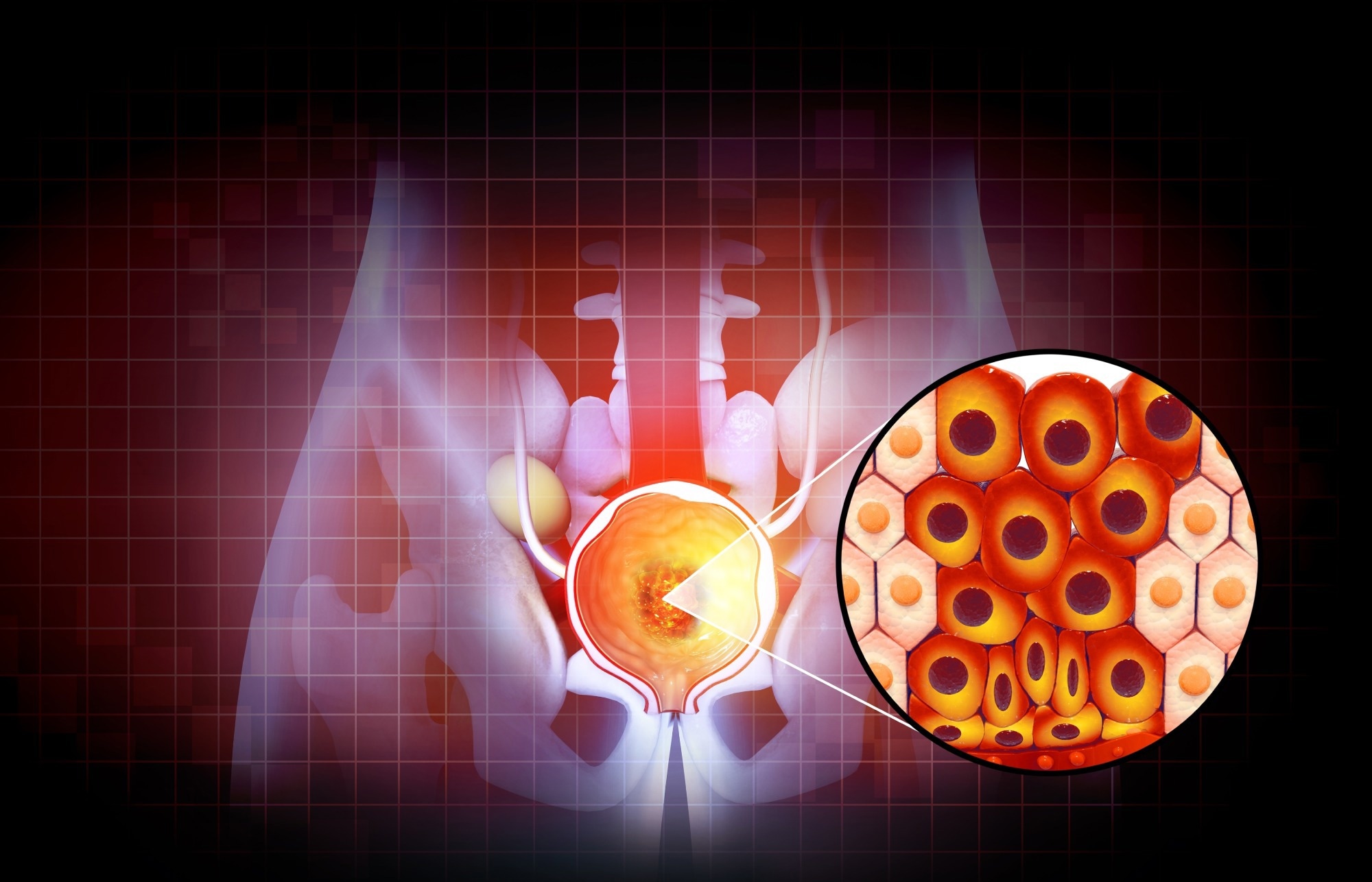 Illustration of prostate disease, Benign prostatic hyperplasia (BPH).