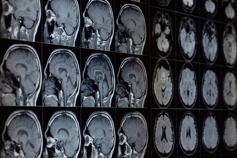 brain scan, forensics