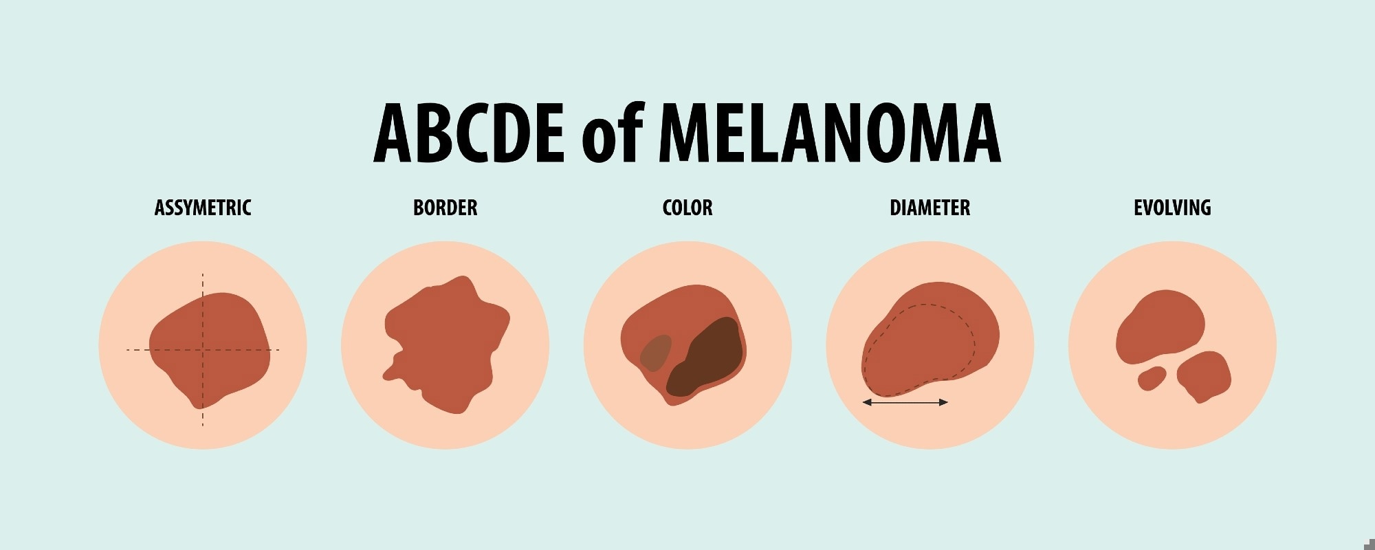 Learn about different types of skin cancer through vector illustrations