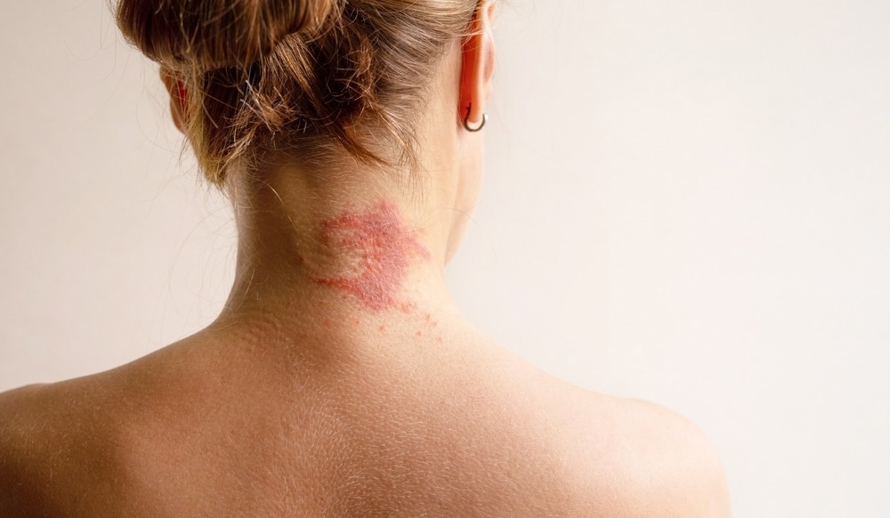 atopic dermatitis