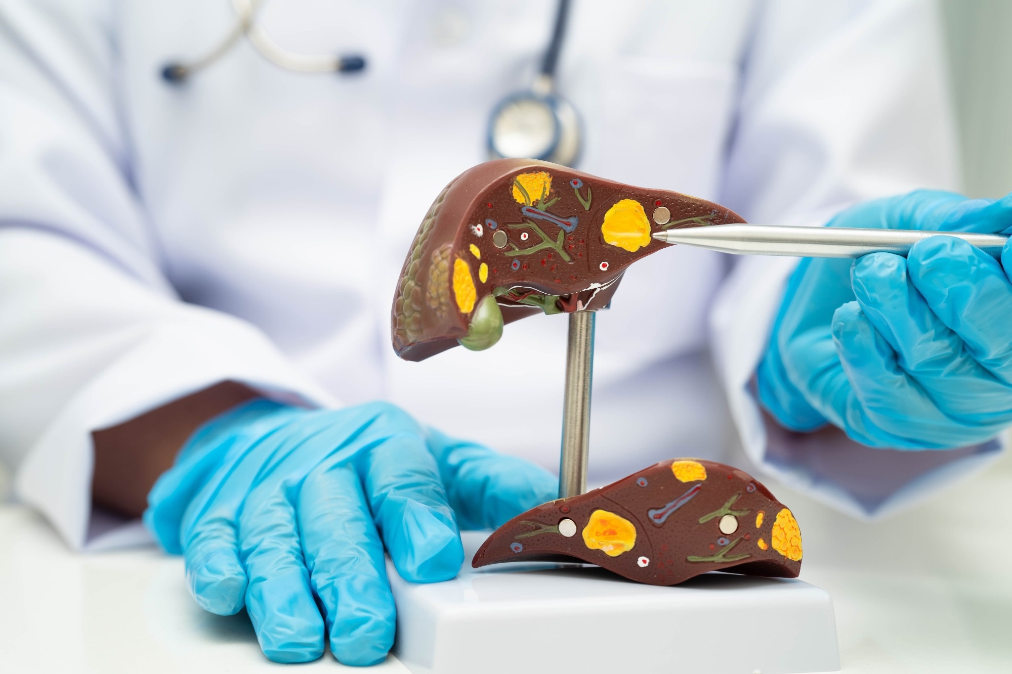 AI Model Detects Fatty Liver Disease from Chest X-Rays with Over 80% Accuracy