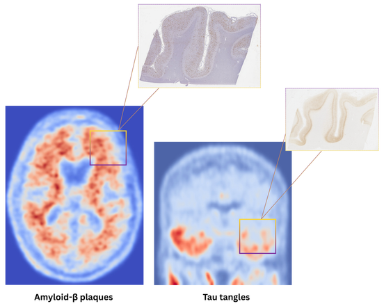 Image shows amyloid and tau PET scans, and corresponding protein (amyloid and tau) deposits in each.