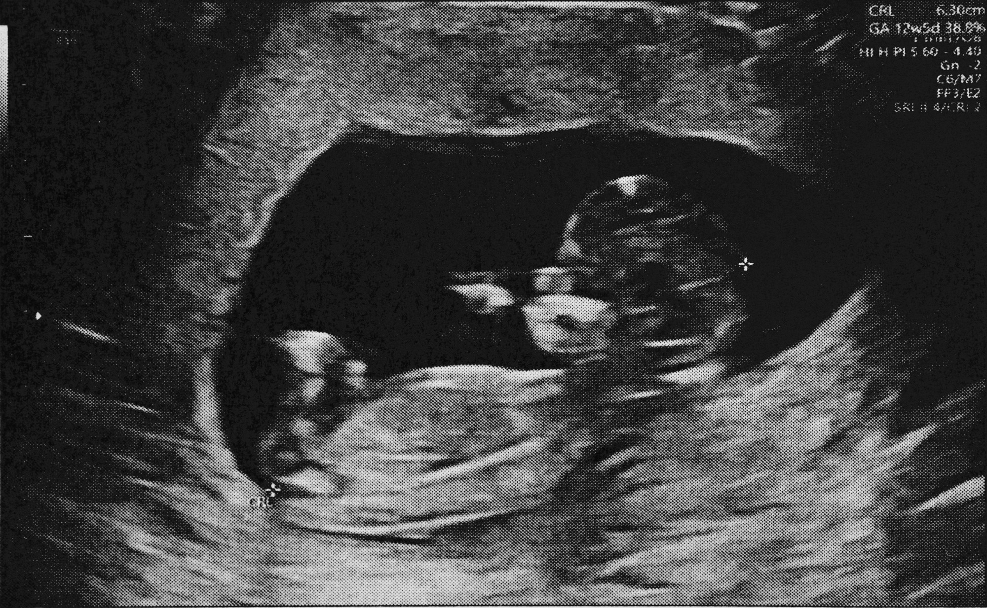 An infant ultrasound image.