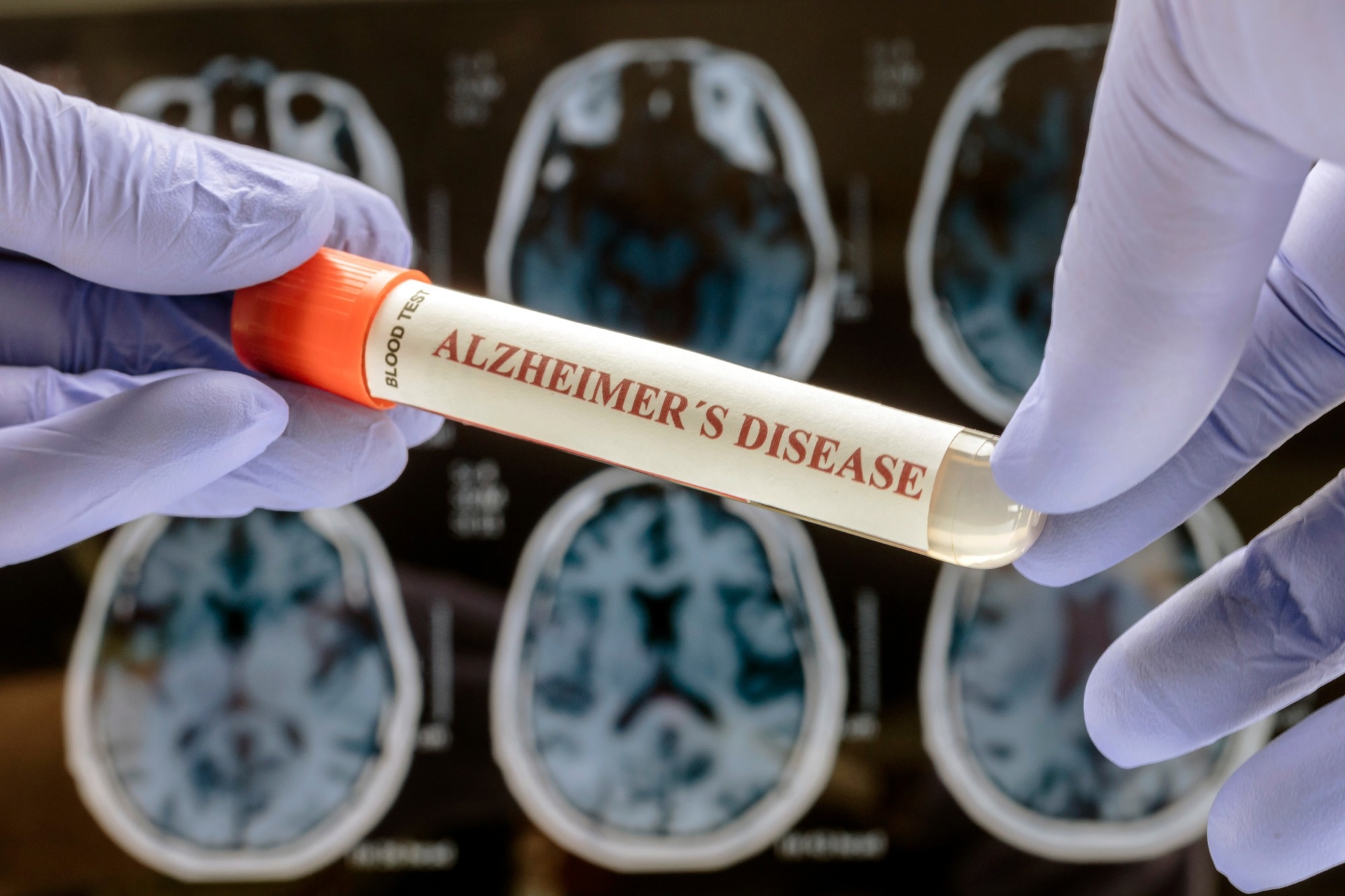 Scientist holds blood sample to investigate remedy against Alzheimer