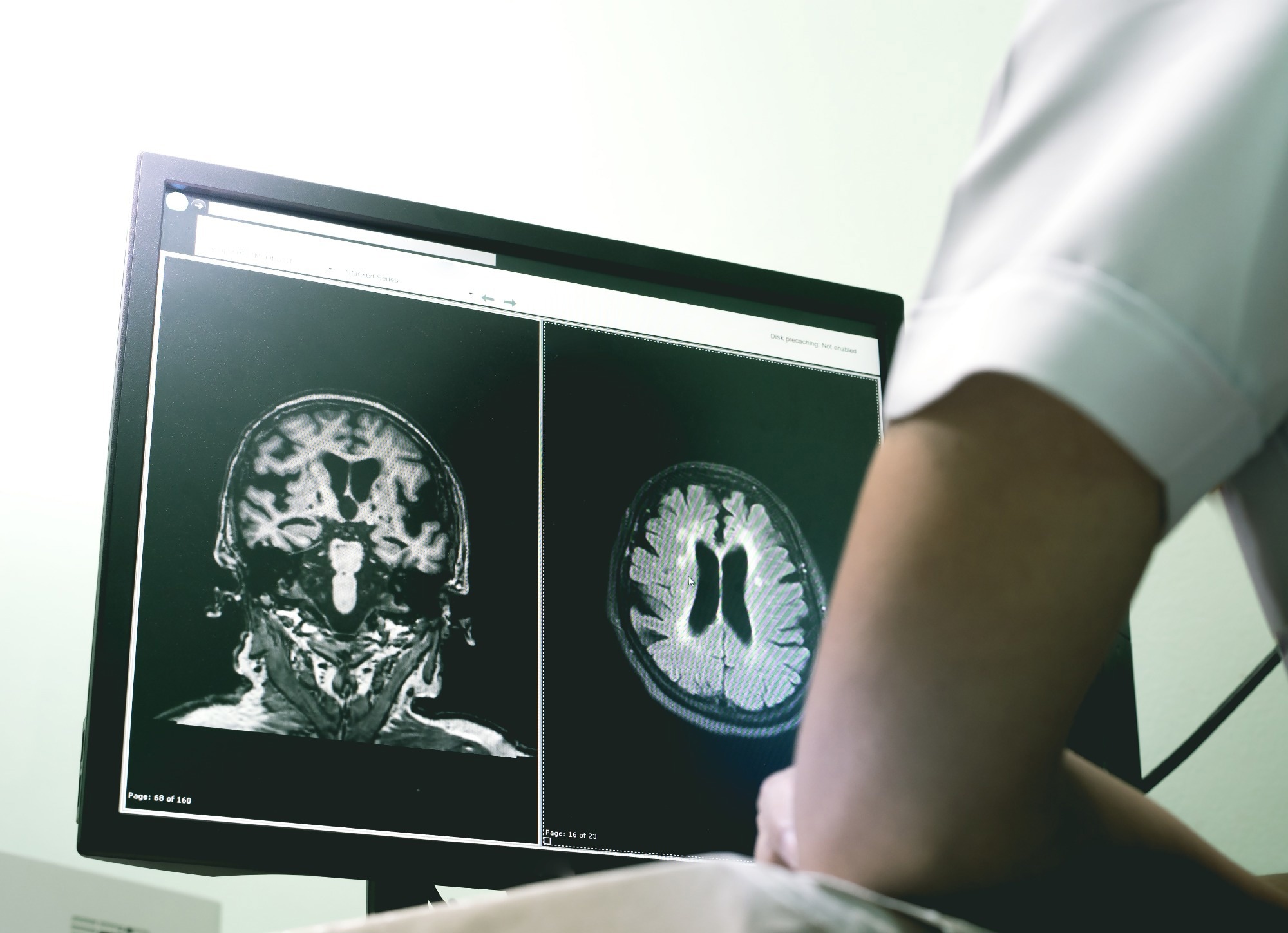 Brain scan showing small vessel disease. Small vessel disease and dementia on film MRI