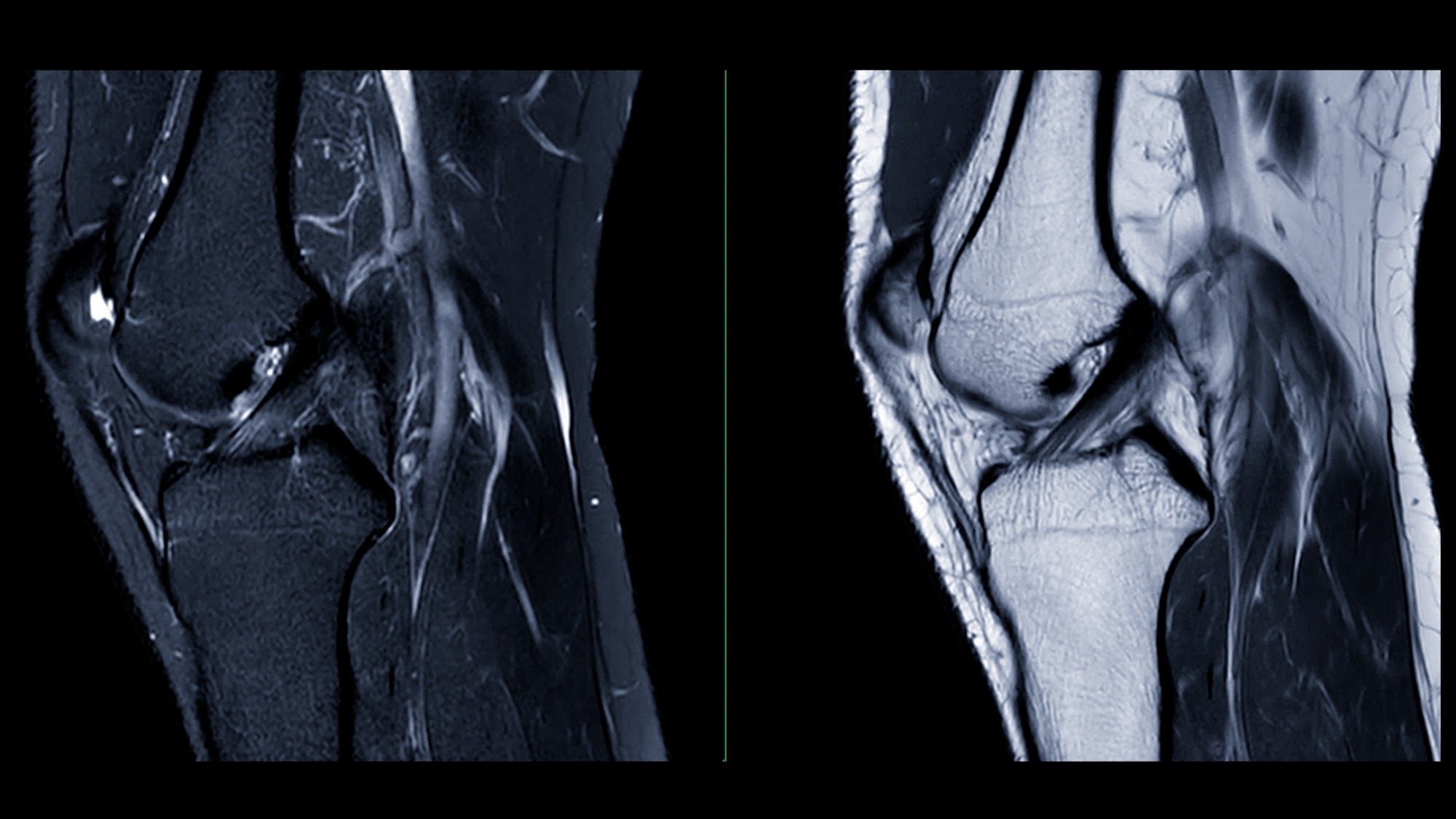 MRI scan of a knee two images revealing the muscles and tendons around a knee joint.