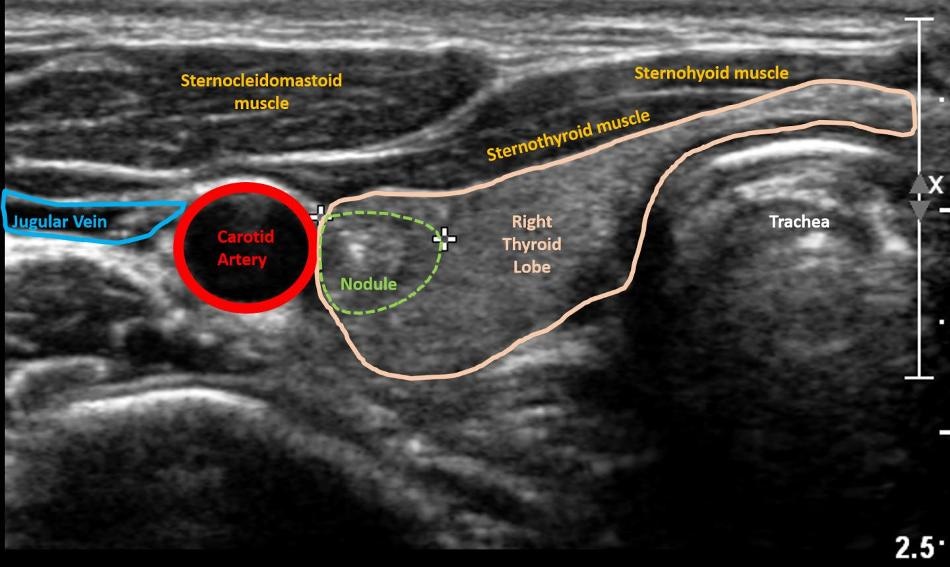 AI Applied to Ultrasound Images of Thyroid Nodules to