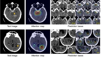 New Artificial Intelligence System Enables Accurate Diagnosis and Classification of Intracranial Hemorrhage