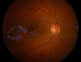 Artificial Intelligence Used to Support Instant Diagnosis of Diabetic Eye Disease