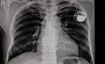 New AI Software can Identify Cardiac Devices More Accurately from X-Ray Images