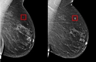 New Deep-Learning Model to Predict Breast Cancer and Customize Care