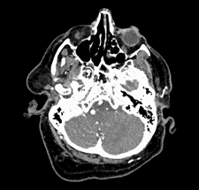 New Artificial Intelligence Tool Improves Diagnoses of Brain Aneurysms