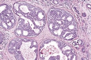 Artificial Intelligence Could Help Achieve More Accurate Diagnosis of Breast Cancer