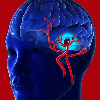 How AI Can be Used to Detect Brain Aneurysms