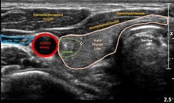 AI Applied to Ultrasound Images of Thyroid Nodules to Predict Risk of Malignancy