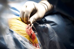 Memorial Neuroscience Institute Uses Minimally-Invasive, Robotic Device to Pinpoint Origin of Epileptic Seizures