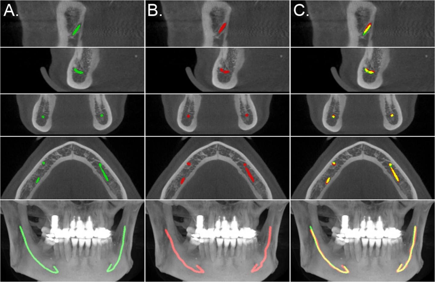 AI Used to Localize Mandibular Canals in Dentistry