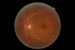 Microbots to Assist in Micro Surgery on Eyes