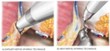 UCLA Study on Robotic-Assisted Prostate Surgery