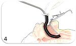 Medrobotics to Market Robot-Assisted Surgical Device Inspired by Snake Robots