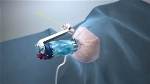 Mazor Robotics’ Renaissance Guidance System Helps Perform First Transcerebellar Brainstem Biopsy
