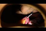 Innovative Application of Magnetic Force Improves Surgery with Robotic Instruments