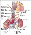 Inferior Vena Cava Thrombectomy Successfully Performed Using Robotic Surgery