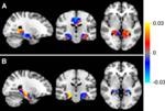 Researchers Incorporate Machine Learning Methods in ASL MRI to Detect Early Dementia