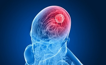 New Artificial Intelligence can Predict Cancer Mechanisms