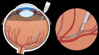 Surgeons of University Hospitals Leuven Perform First Ever Robot-Assisted Retinal Vein Occlusion