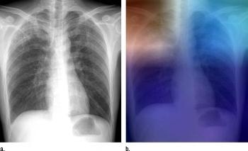 Researchers Aim to Use AI to Help Screen and Diagnose Tuberculosis in Remote Areas