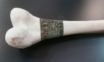 Innovative 3D Implants Set to Revolutionize Tumor Surgery
