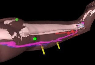 Surgeons Can ‘See Through’ Tissue to Reconnect Blood Vessels Using Augmented Reality