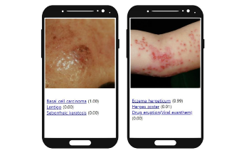 AI Algorithm Improves Diagnostic Accuracy of Skin Disorders