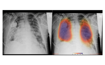 New AI Algorithm Allows Rapid Detection of COVID-19