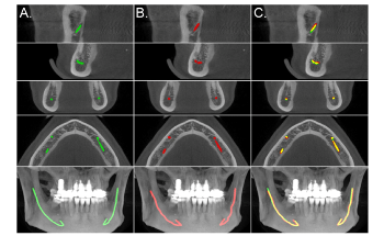 New AI Model Accurately Shows Location of Mandibular Canals