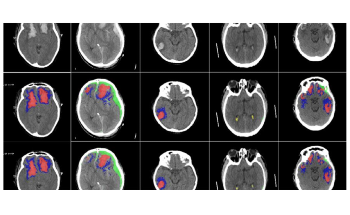 New AI Algorithm to Identify Different Types of Brain Injuries