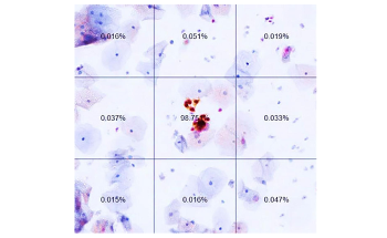 AI-Based Dual-Stain Test Improves Cervical Cancer Diagnosis