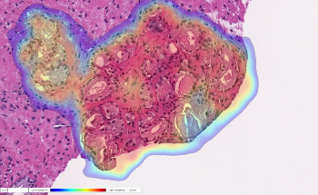 Researchers Train AI Algorithm to Recognize and Characterize Prostate Cancer