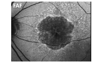 New AI-Based Software Precisely Assesses Progression of Retinal Legions from Geographic Atrophy